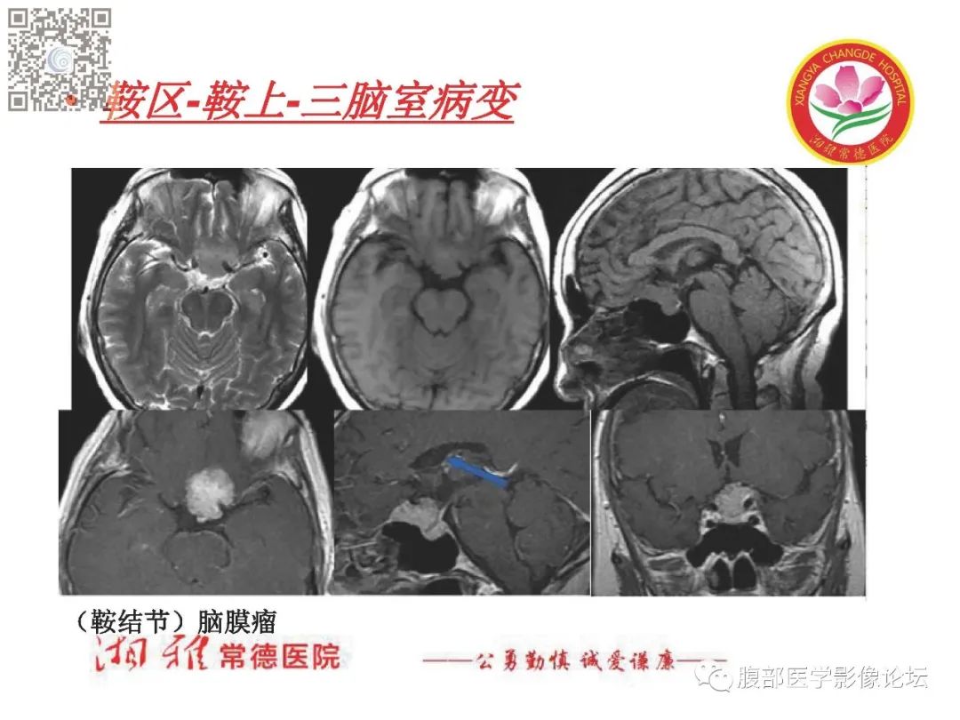 影像PPT - 【PPT】脑中线结构区域解剖及病变影像-34