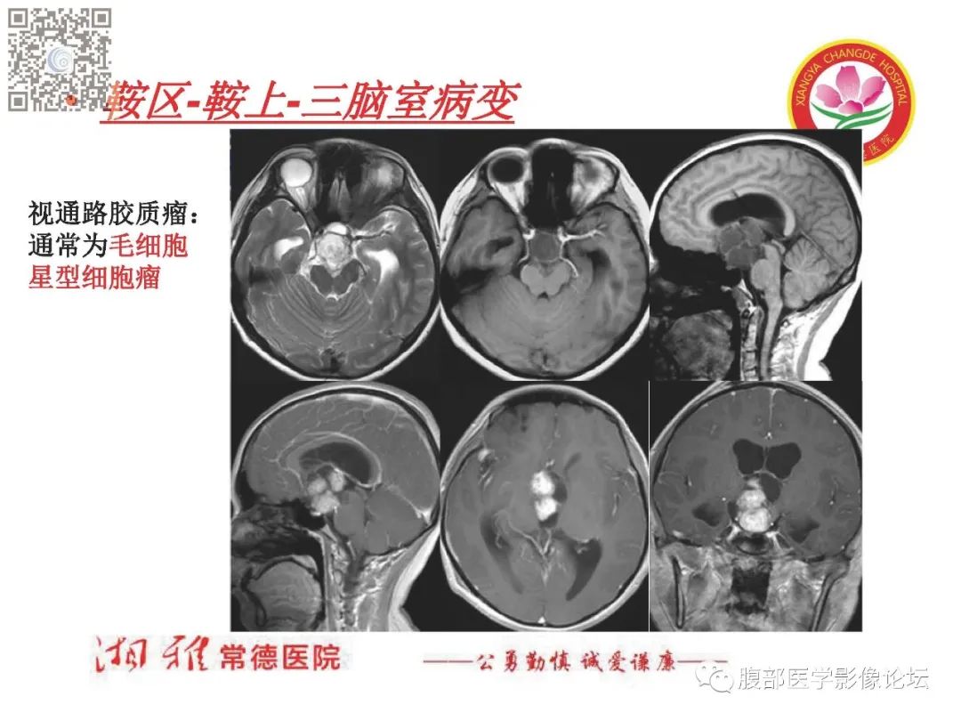 影像PPT - 【PPT】脑中线结构区域解剖及病变影像-36