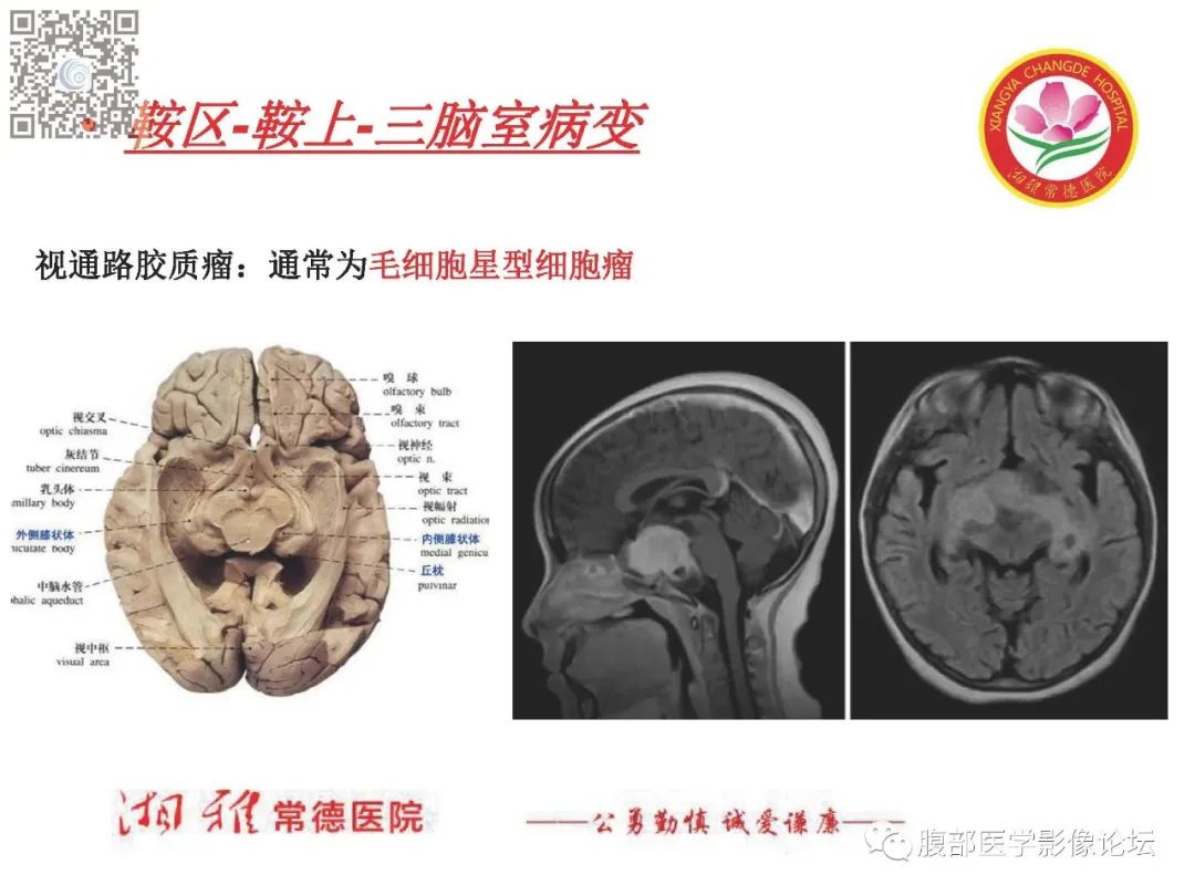 影像PPT - 【PPT】脑中线结构区域解剖及病变影像-37