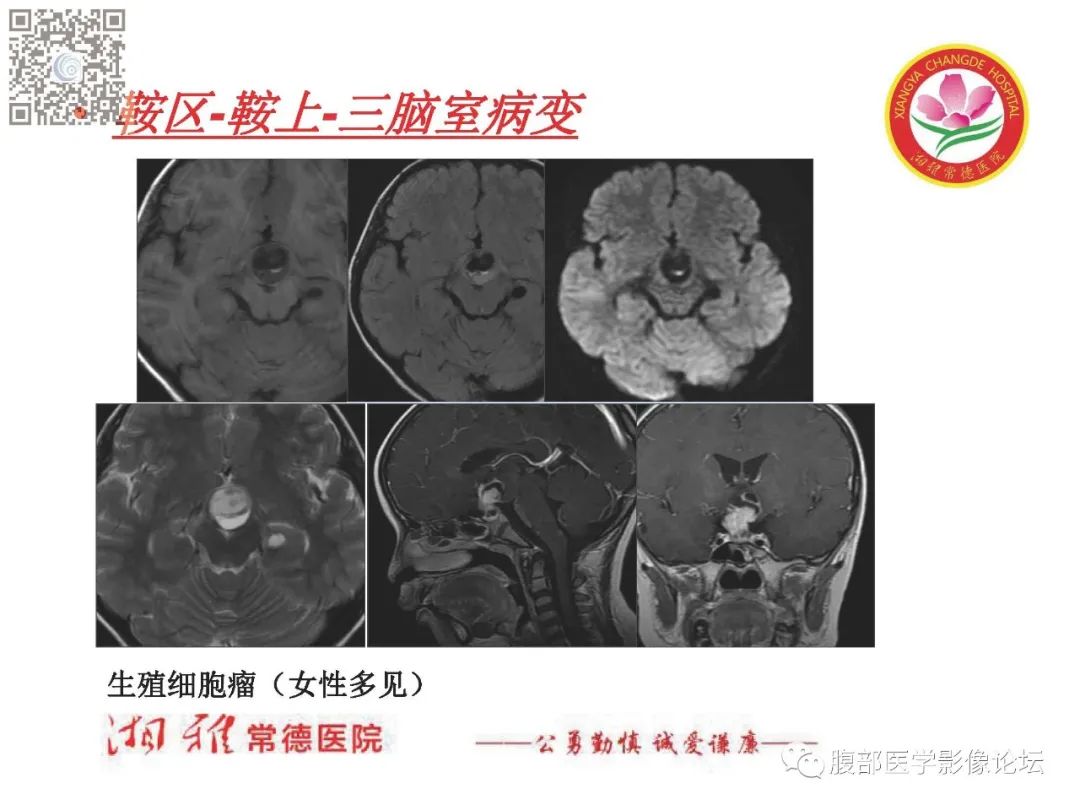 影像PPT - 【PPT】脑中线结构区域解剖及病变影像-38