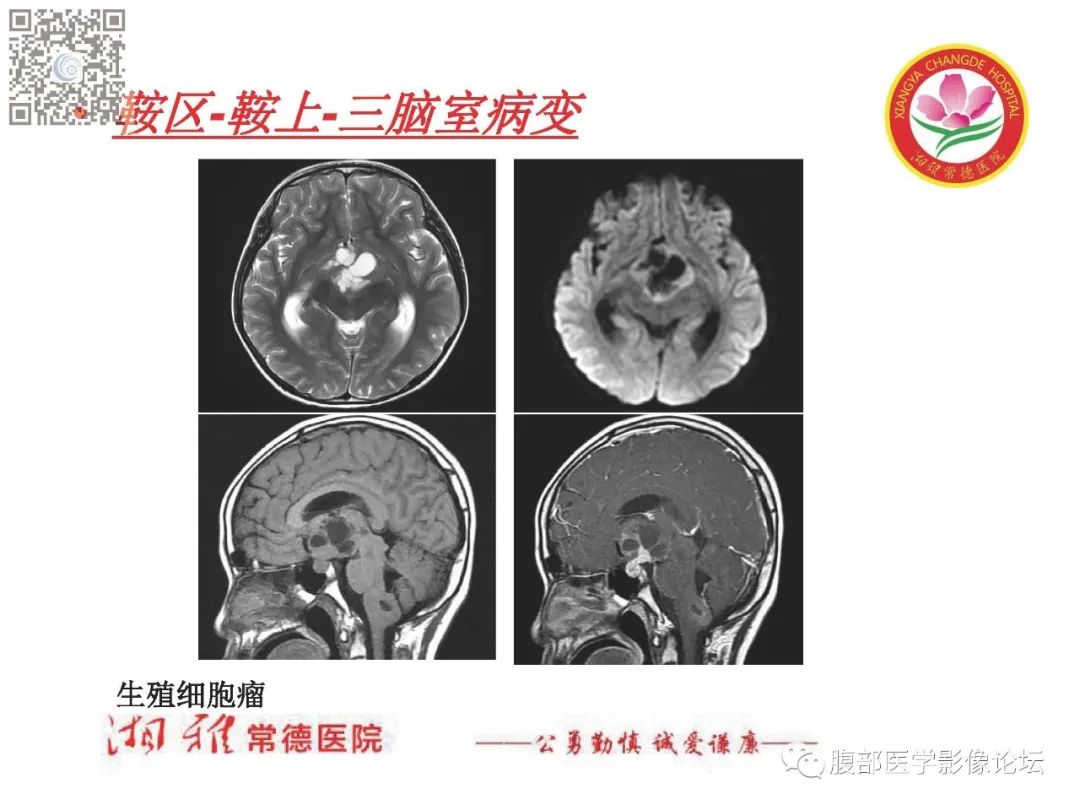 影像PPT - 【PPT】脑中线结构区域解剖及病变影像-39