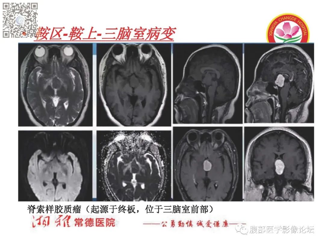 影像PPT - 【PPT】脑中线结构区域解剖及病变影像-41