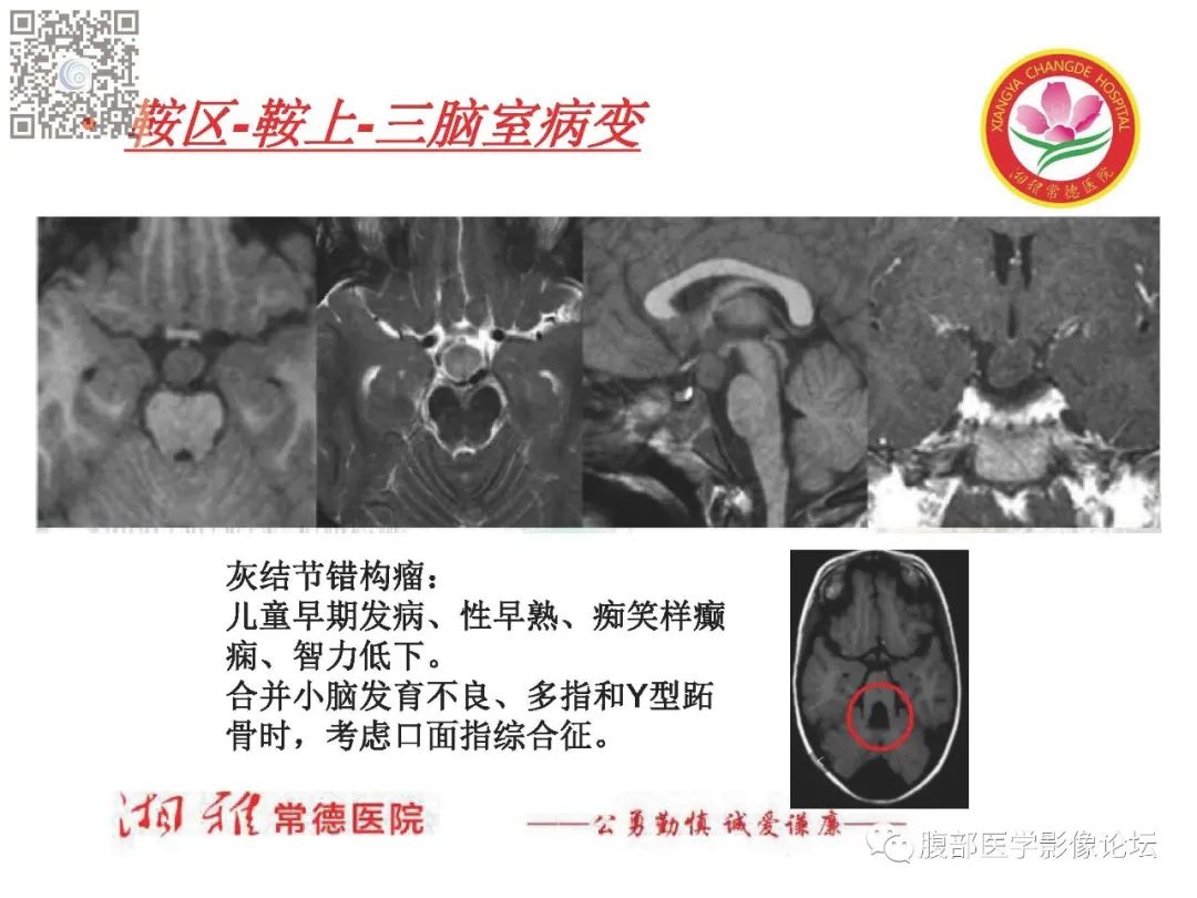 影像PPT - 【PPT】脑中线结构区域解剖及病变影像-40