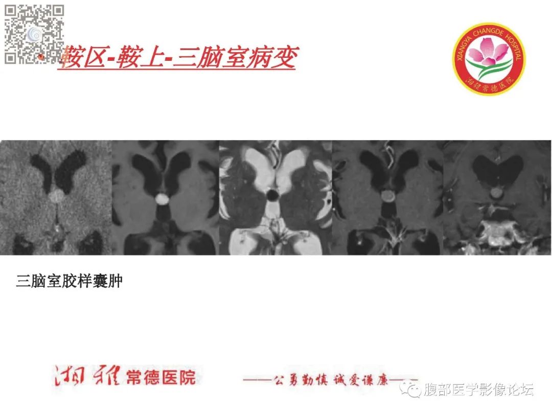 影像PPT - 【PPT】脑中线结构区域解剖及病变影像-42