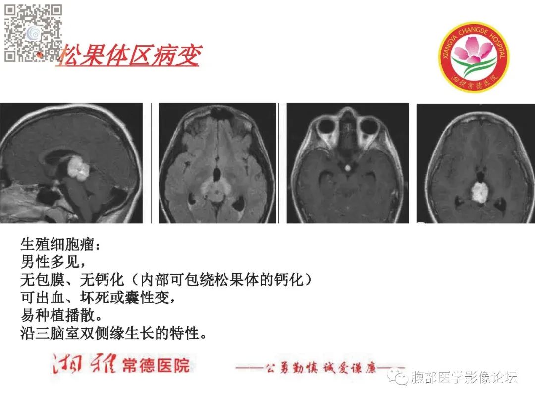 影像PPT - 【PPT】脑中线结构区域解剖及病变影像-44