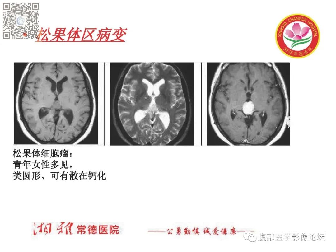 影像PPT - 【PPT】脑中线结构区域解剖及病变影像-45