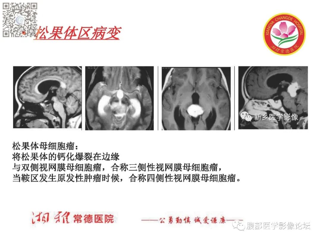 影像PPT - 【PPT】脑中线结构区域解剖及病变影像-46