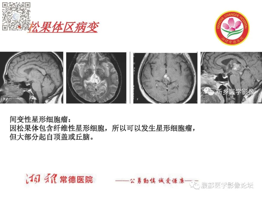 影像PPT - 【PPT】脑中线结构区域解剖及病变影像-47