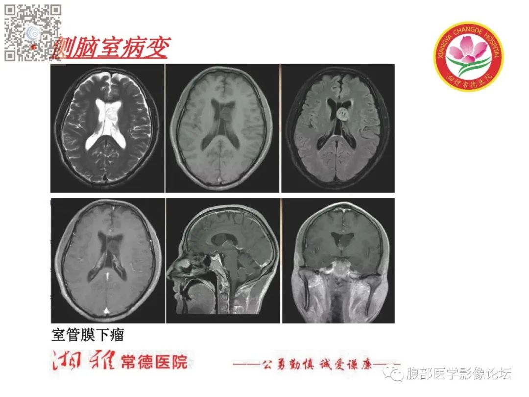 影像PPT - 【PPT】脑中线结构区域解剖及病变影像-49