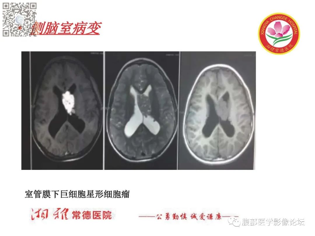 影像PPT - 【PPT】脑中线结构区域解剖及病变影像-51