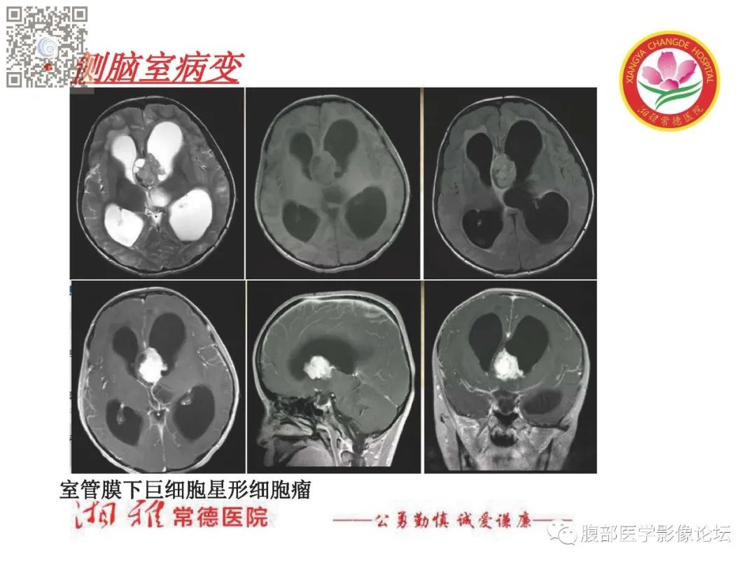 影像PPT - 【PPT】脑中线结构区域解剖及病变影像-52
