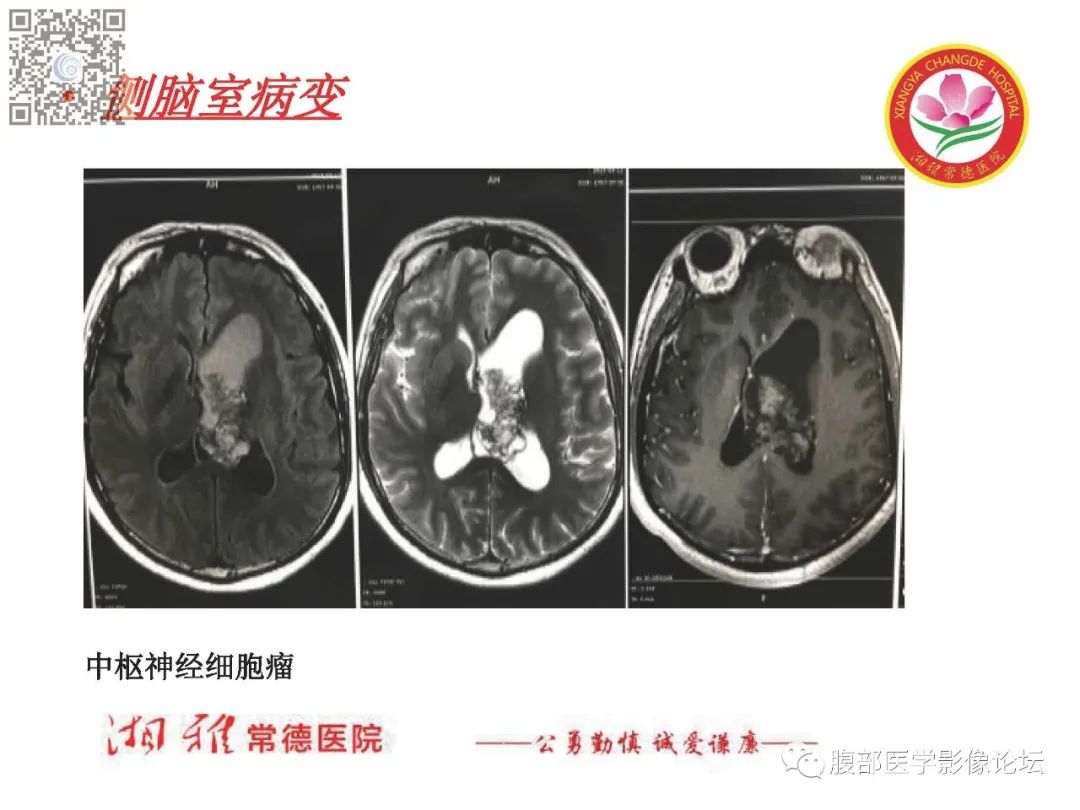 影像PPT - 【PPT】脑中线结构区域解剖及病变影像-50