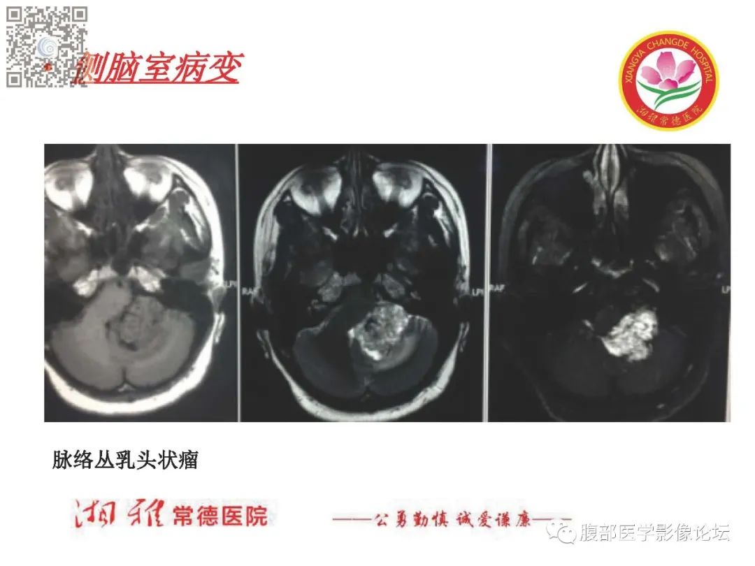 影像PPT - 【PPT】脑中线结构区域解剖及病变影像-54