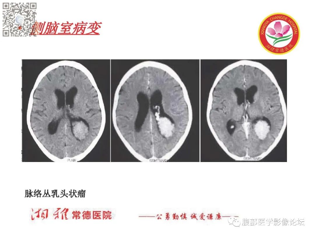 影像PPT - 【PPT】脑中线结构区域解剖及病变影像-53