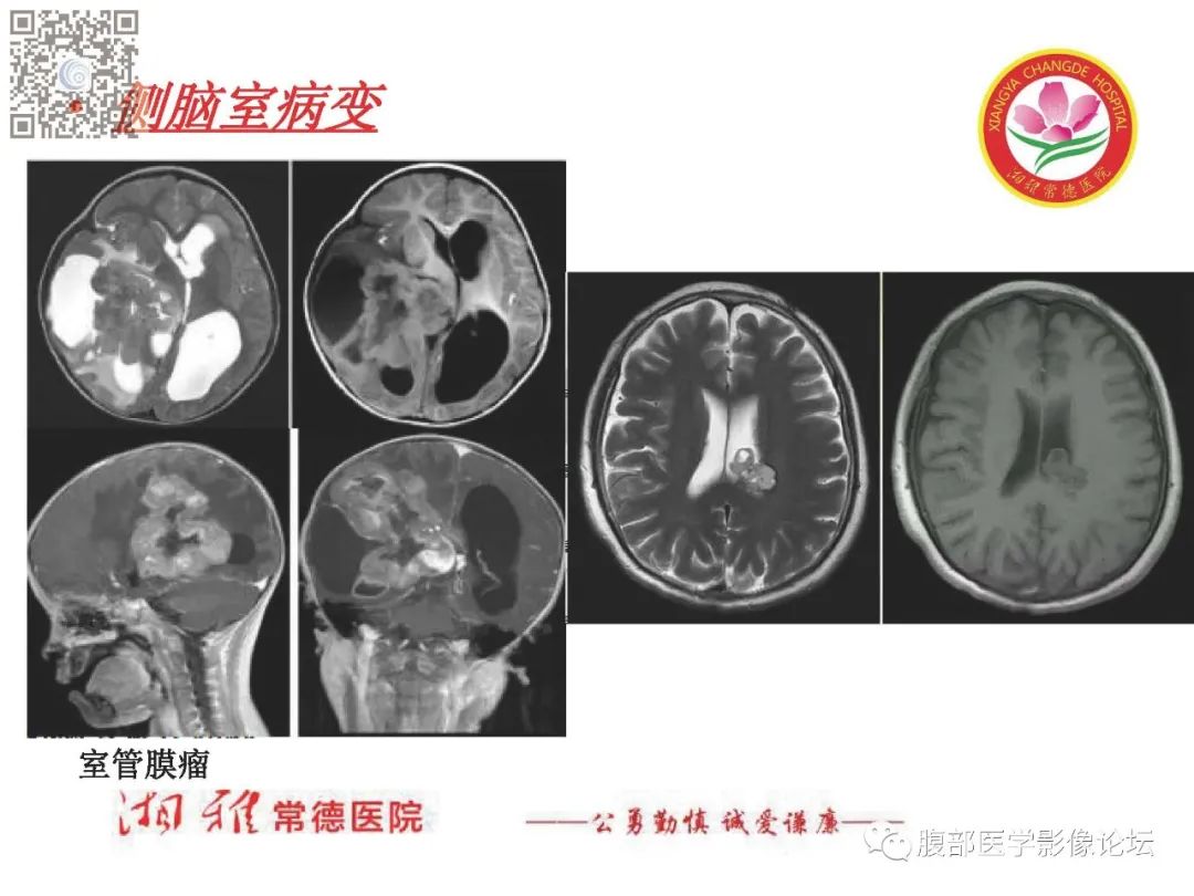影像PPT - 【PPT】脑中线结构区域解剖及病变影像-55