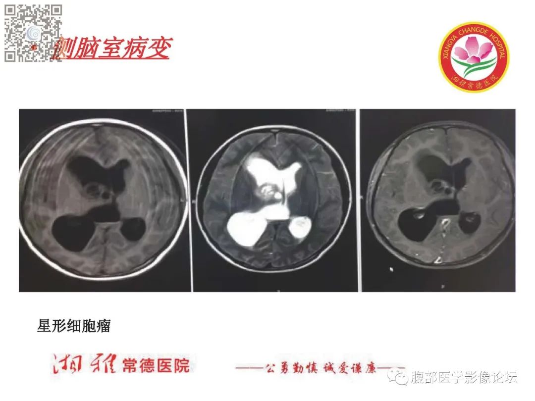 影像PPT - 【PPT】脑中线结构区域解剖及病变影像-57