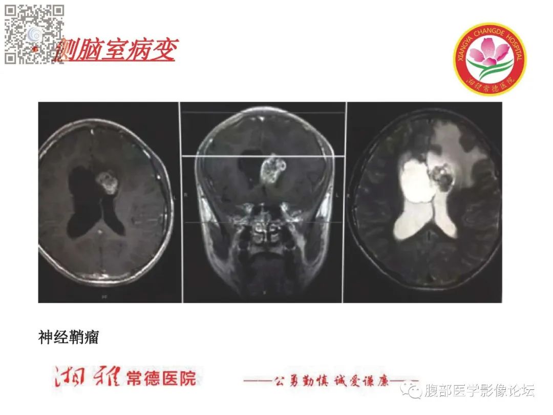 影像PPT - 【PPT】脑中线结构区域解剖及病变影像-58