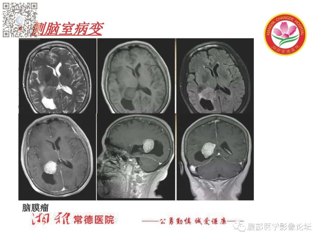 影像PPT - 【PPT】脑中线结构区域解剖及病变影像-56