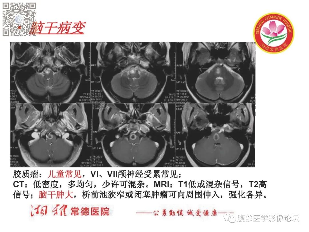 影像PPT - 【PPT】脑中线结构区域解剖及病变影像-60