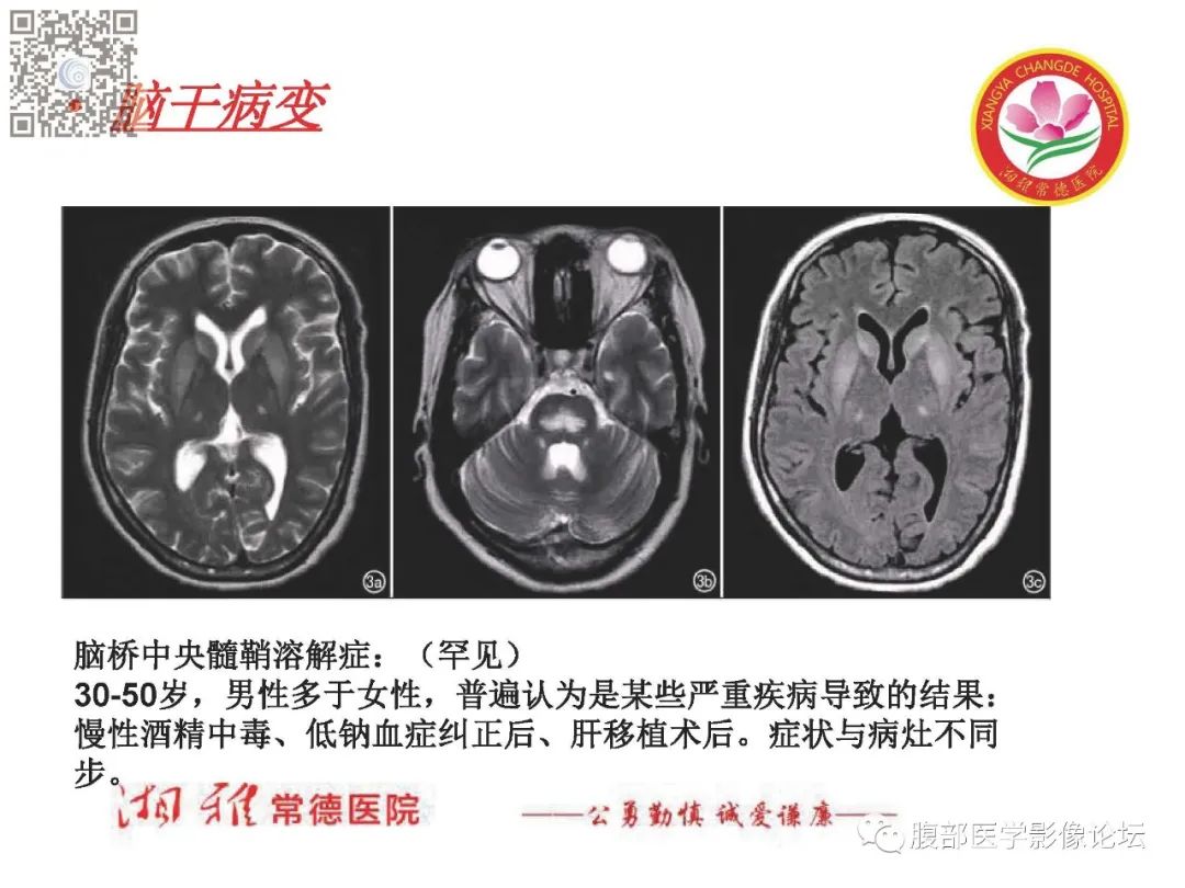 影像PPT - 【PPT】脑中线结构区域解剖及病变影像-63