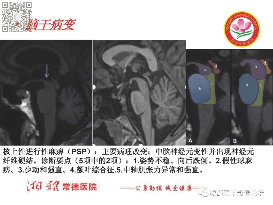 影像PPT - 【PPT】脑中线结构区域解剖及病变影像-65