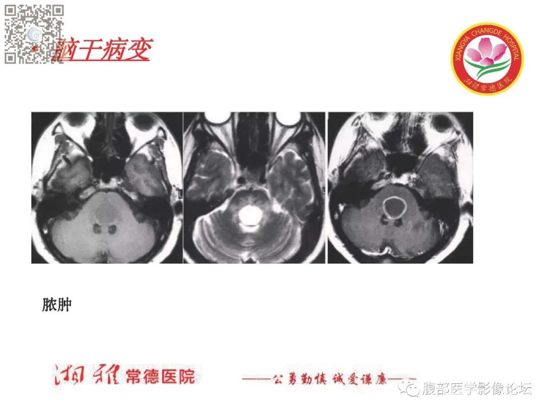 影像PPT - 【PPT】脑中线结构区域解剖及病变影像-62