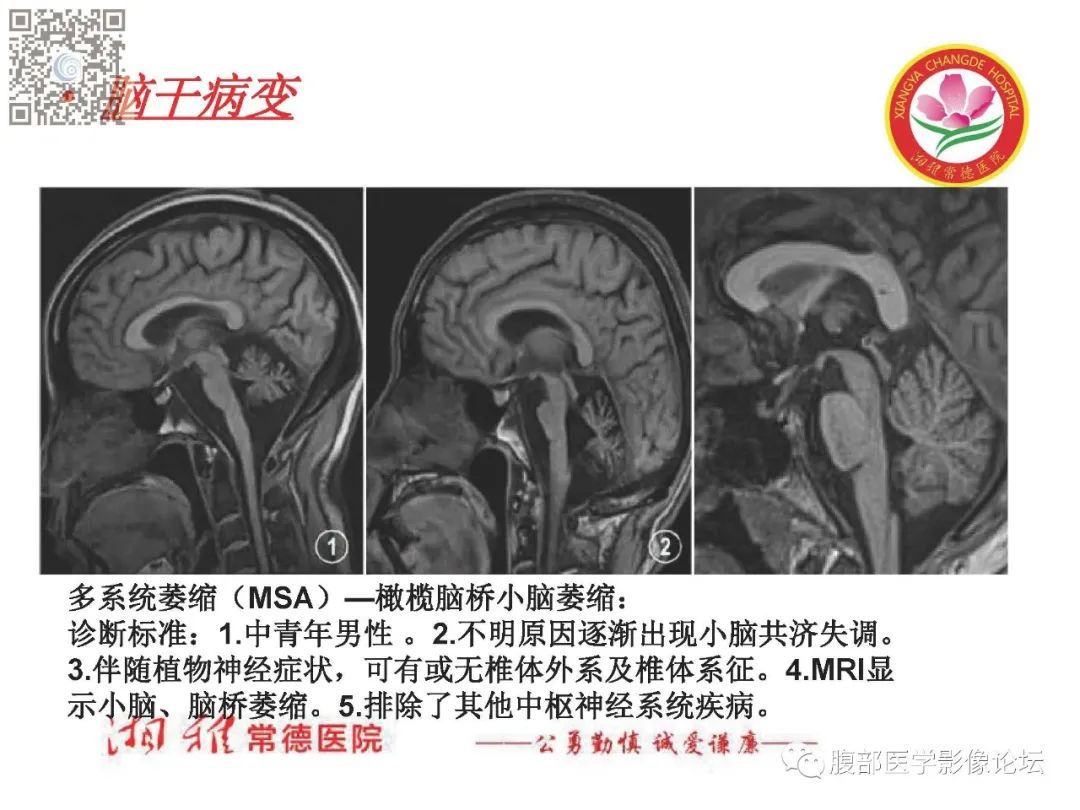 影像PPT - 【PPT】脑中线结构区域解剖及病变影像-64