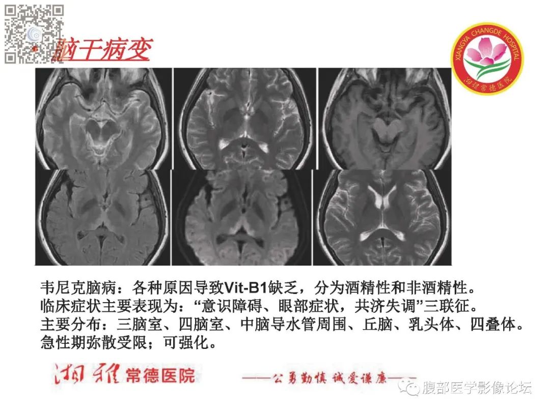 影像PPT - 【PPT】脑中线结构区域解剖及病变影像-66