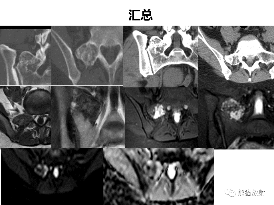 影像PPT - 【病例】骶骨骨巨细胞瘤 VS 软骨肉瘤-23