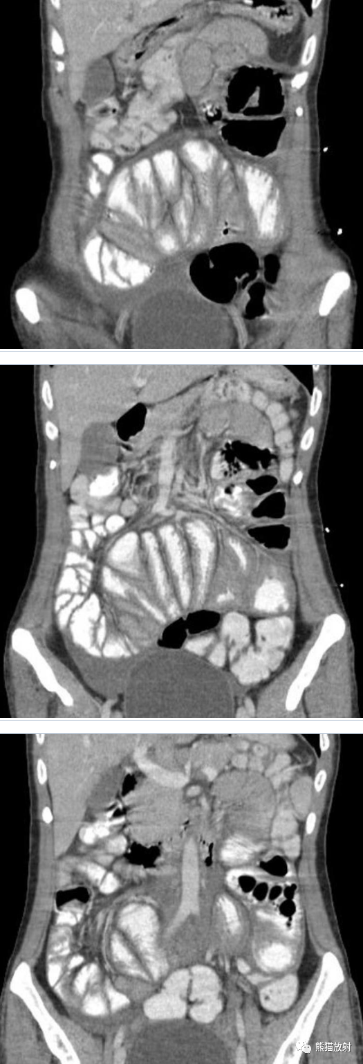 影像PPT - 【病例】腹茧症1例CT影像-3 影像PPT - 【病例】腹茧症1例CT影像-3