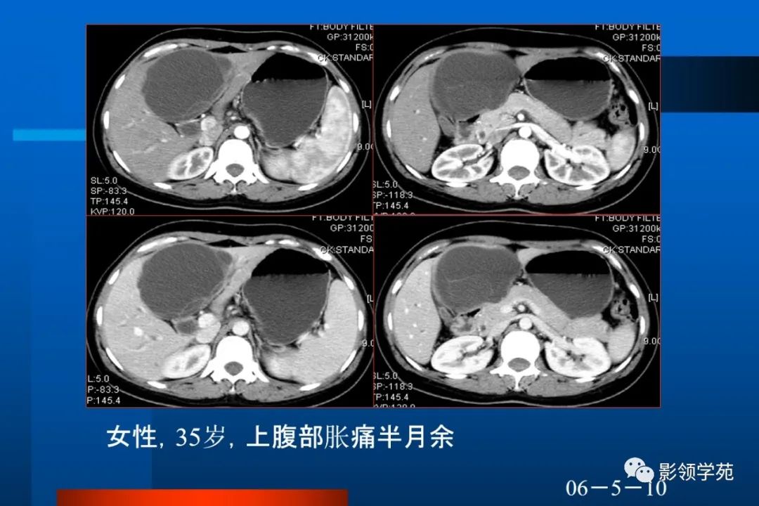 影像PPT - 【PPT】肝脏囊性病变的影像诊断-5