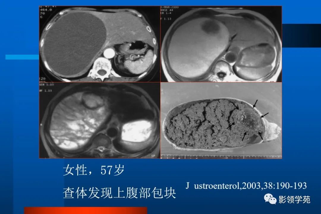 影像PPT - 【PPT】肝脏囊性病变的影像诊断-6