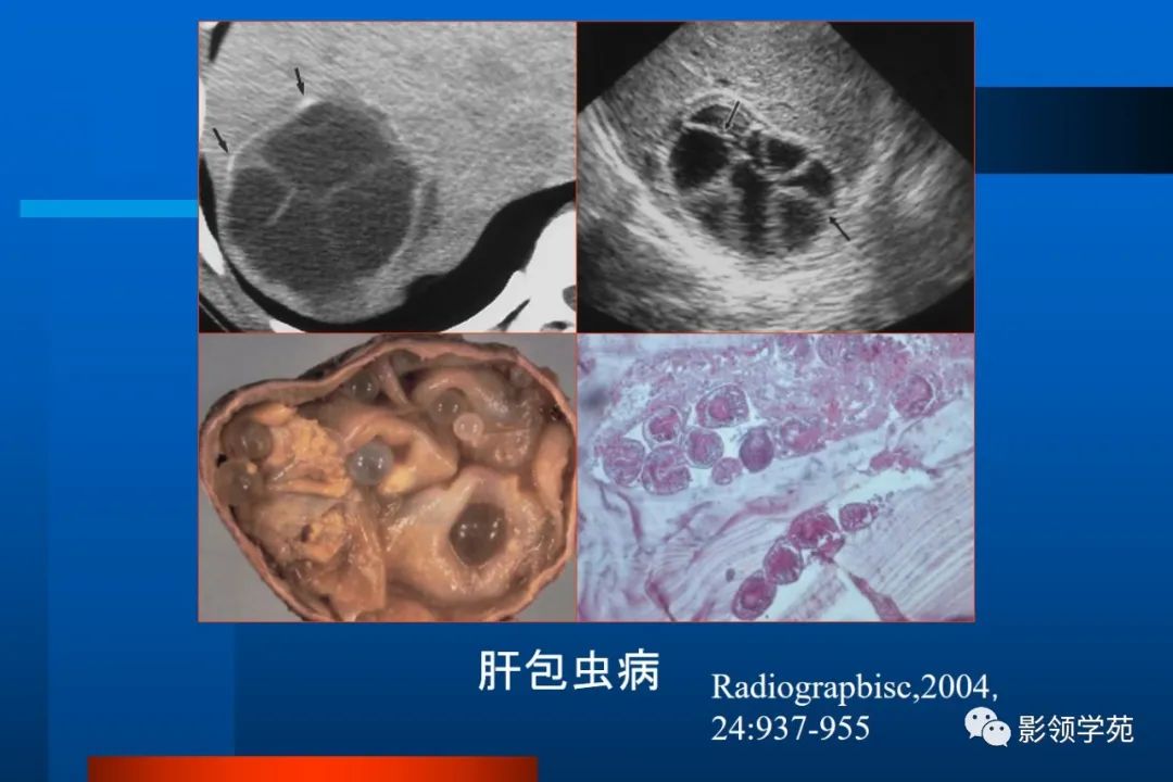 影像PPT - 【PPT】肝脏囊性病变的影像诊断-9