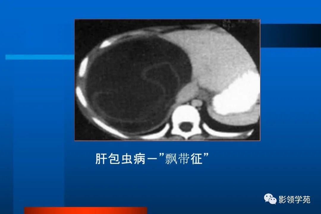 影像PPT - 【PPT】肝脏囊性病变的影像诊断-10