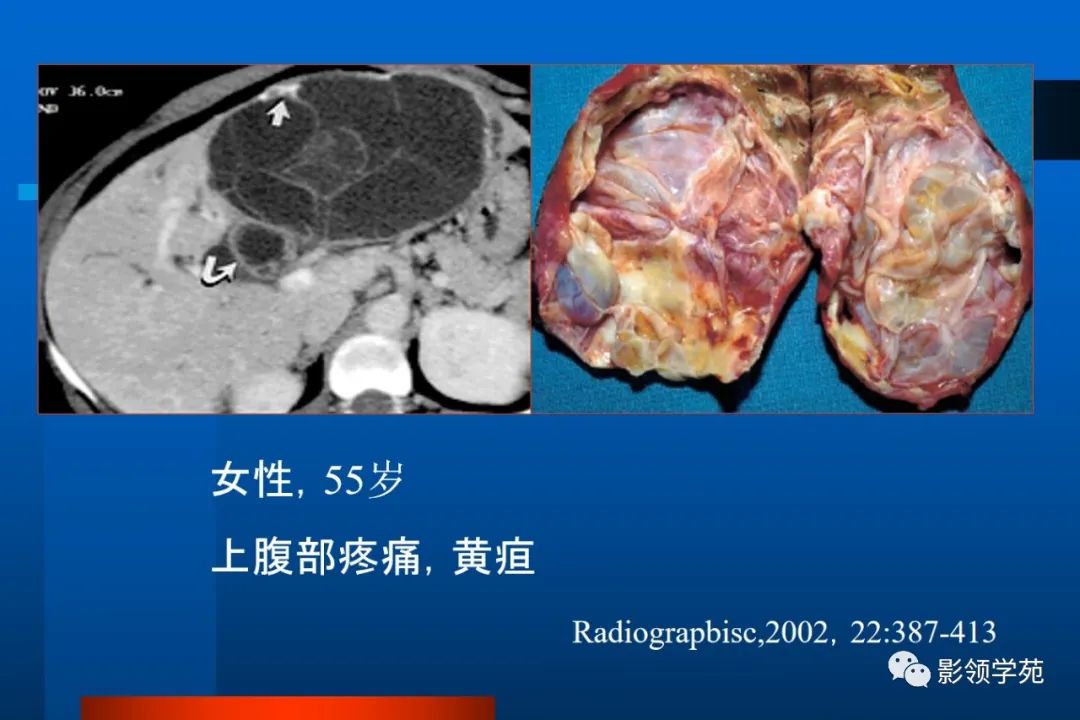 影像PPT - 【PPT】肝脏囊性病变的影像诊断-12