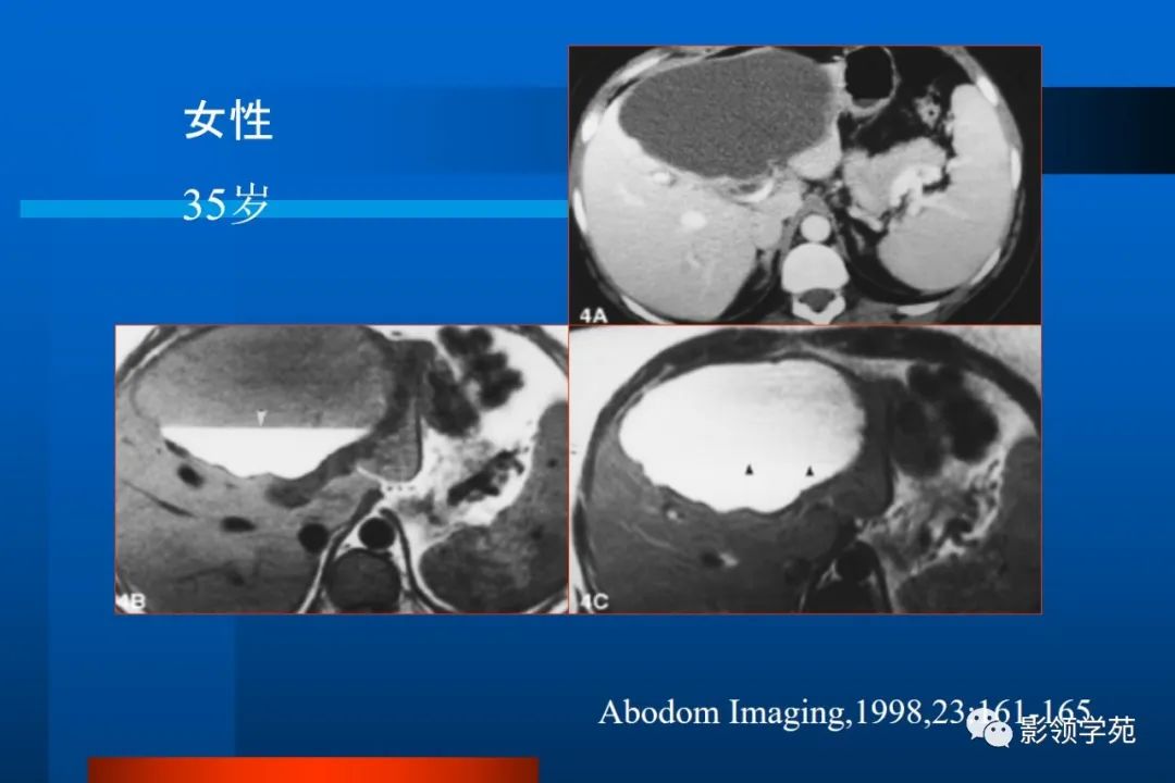 影像PPT - 【PPT】肝脏囊性病变的影像诊断-15