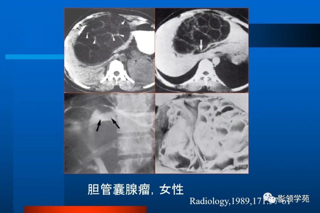 影像PPT - 【PPT】肝脏囊性病变的影像诊断-14