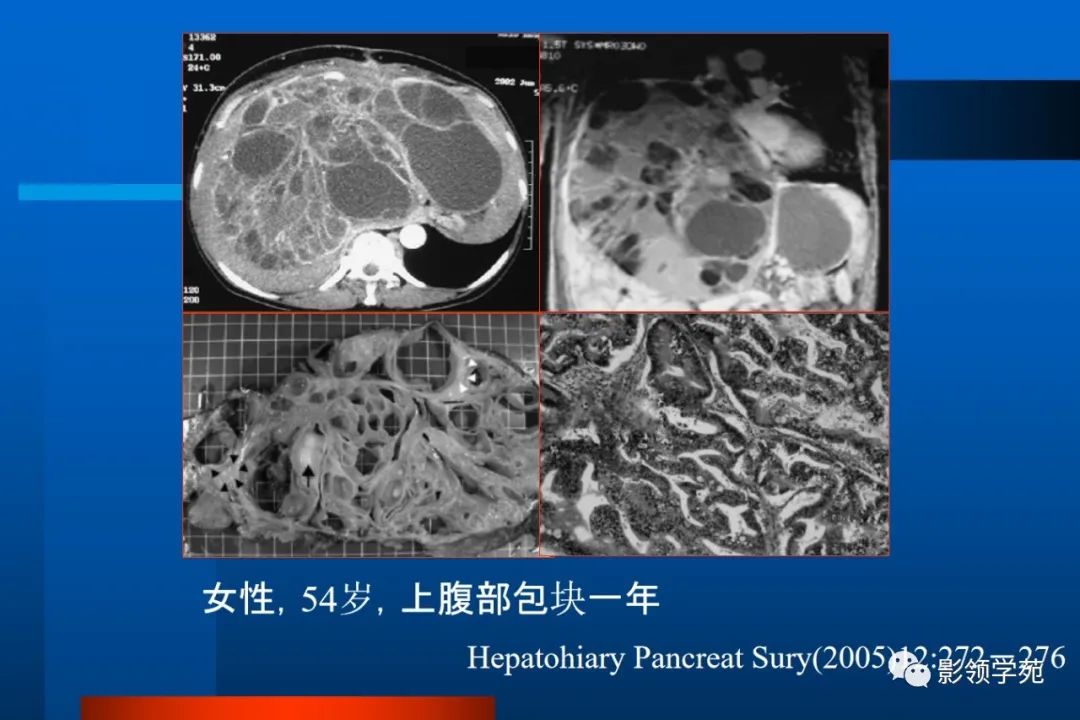 影像PPT - 【PPT】肝脏囊性病变的影像诊断-13