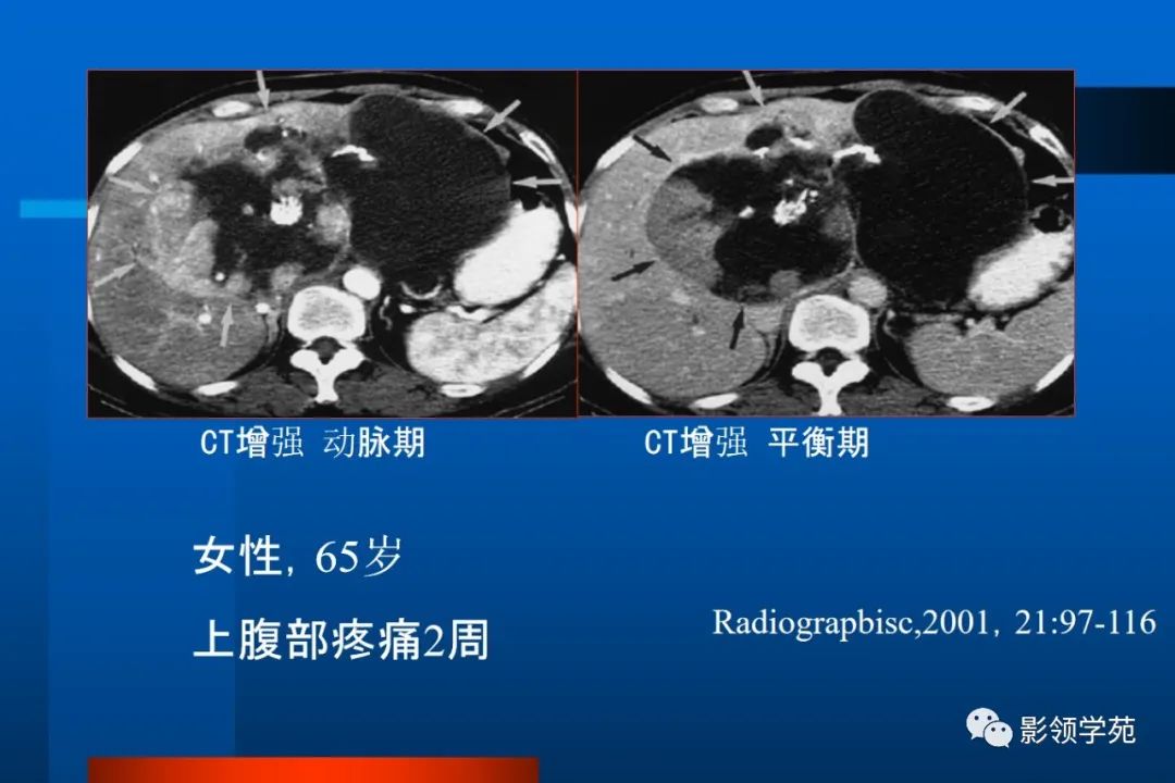 影像PPT - 【PPT】肝脏囊性病变的影像诊断-19