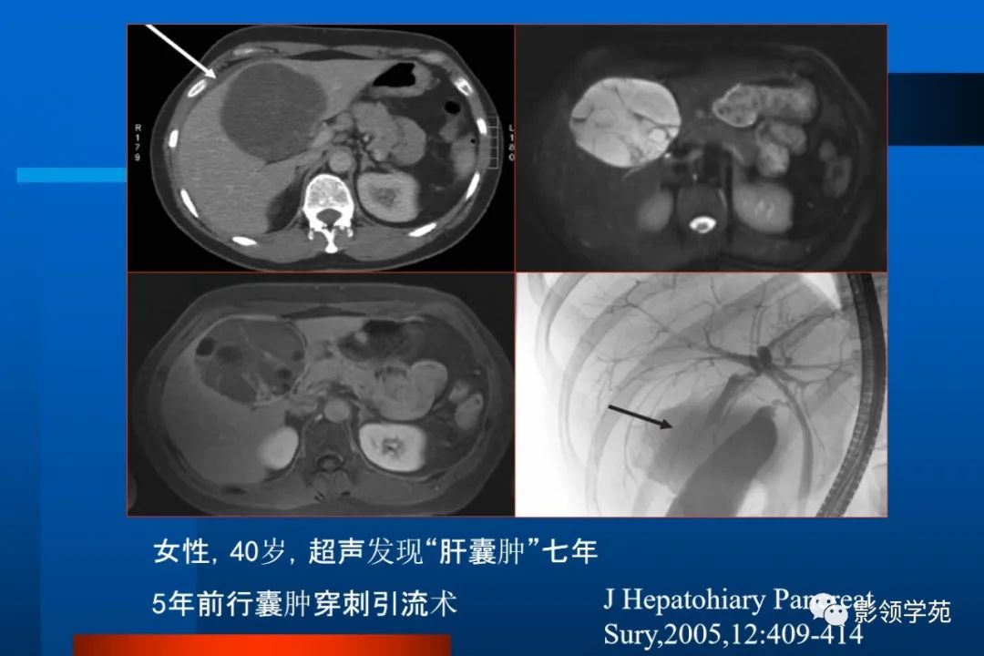 影像PPT - 【PPT】肝脏囊性病变的影像诊断-20