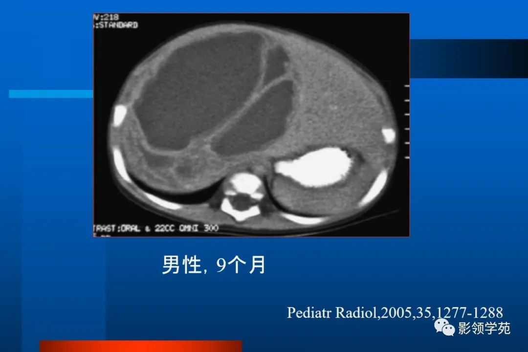 影像PPT - 【PPT】肝脏囊性病变的影像诊断-23