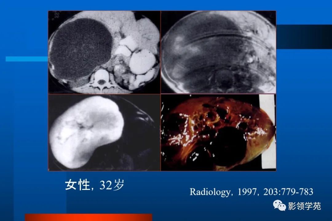 影像PPT - 【PPT】肝脏囊性病变的影像诊断-28