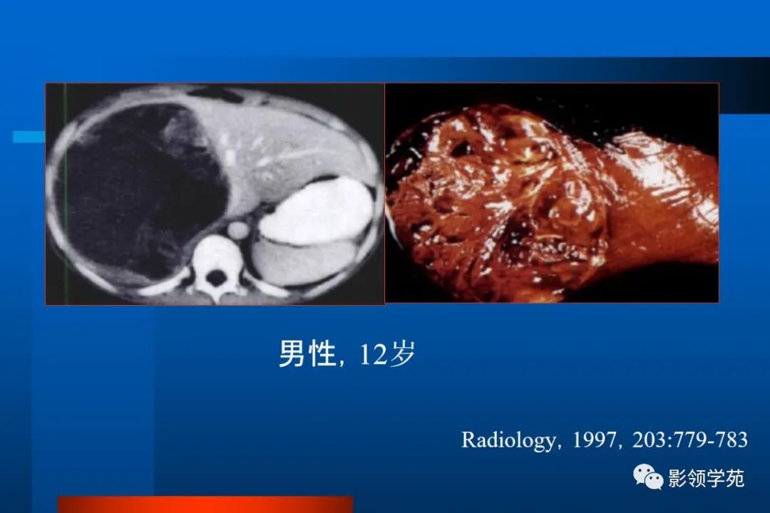 影像PPT - 【PPT】肝脏囊性病变的影像诊断-27