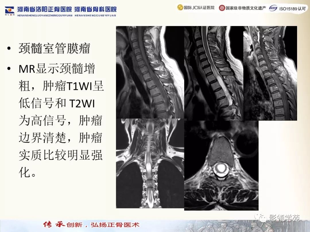 影像PPT - 【PPT】椎管内常见肿瘤MR诊断-4 影像PPT - 【PPT】椎管内常见肿瘤MR诊断-4