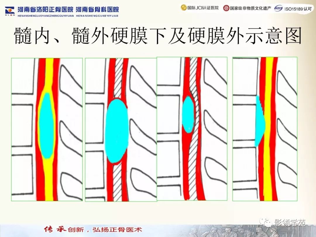 影像PPT - 【PPT】椎管内常见肿瘤MR诊断-2 影像PPT - 【PPT】椎管内常见肿瘤MR诊断-2