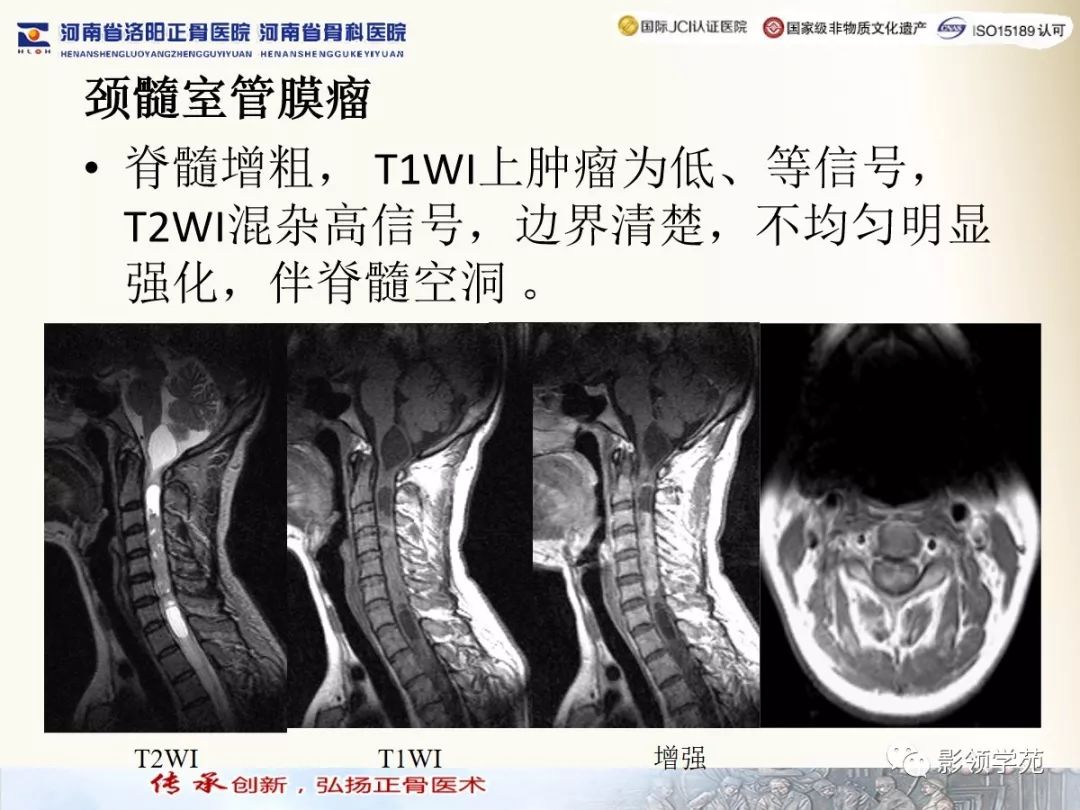 影像PPT - 【PPT】椎管内常见肿瘤MR诊断-5 影像PPT - 【PPT】椎管内常见肿瘤MR诊断-5