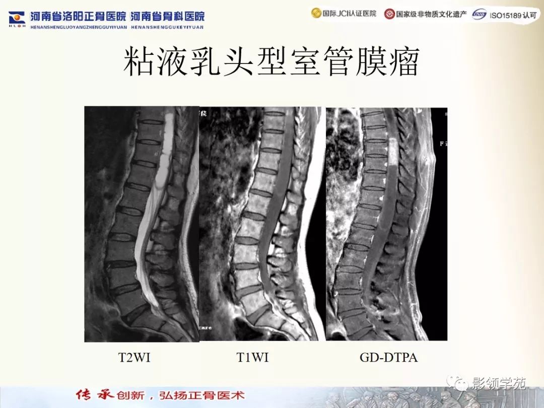 影像PPT - 【PPT】椎管内常见肿瘤MR诊断-6 影像PPT - 【PPT】椎管内常见肿瘤MR诊断-6