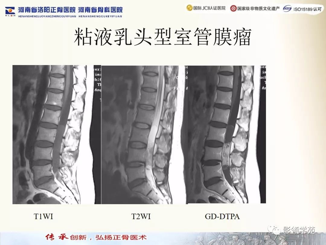 影像PPT - 【PPT】椎管内常见肿瘤MR诊断-7 影像PPT - 【PPT】椎管内常见肿瘤MR诊断-7