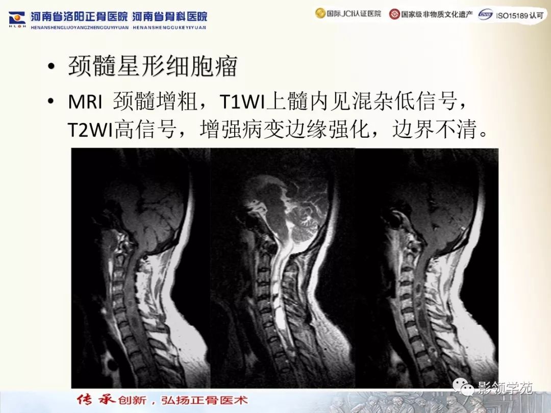 影像PPT - 【PPT】椎管内常见肿瘤MR诊断-9 影像PPT - 【PPT】椎管内常见肿瘤MR诊断-9