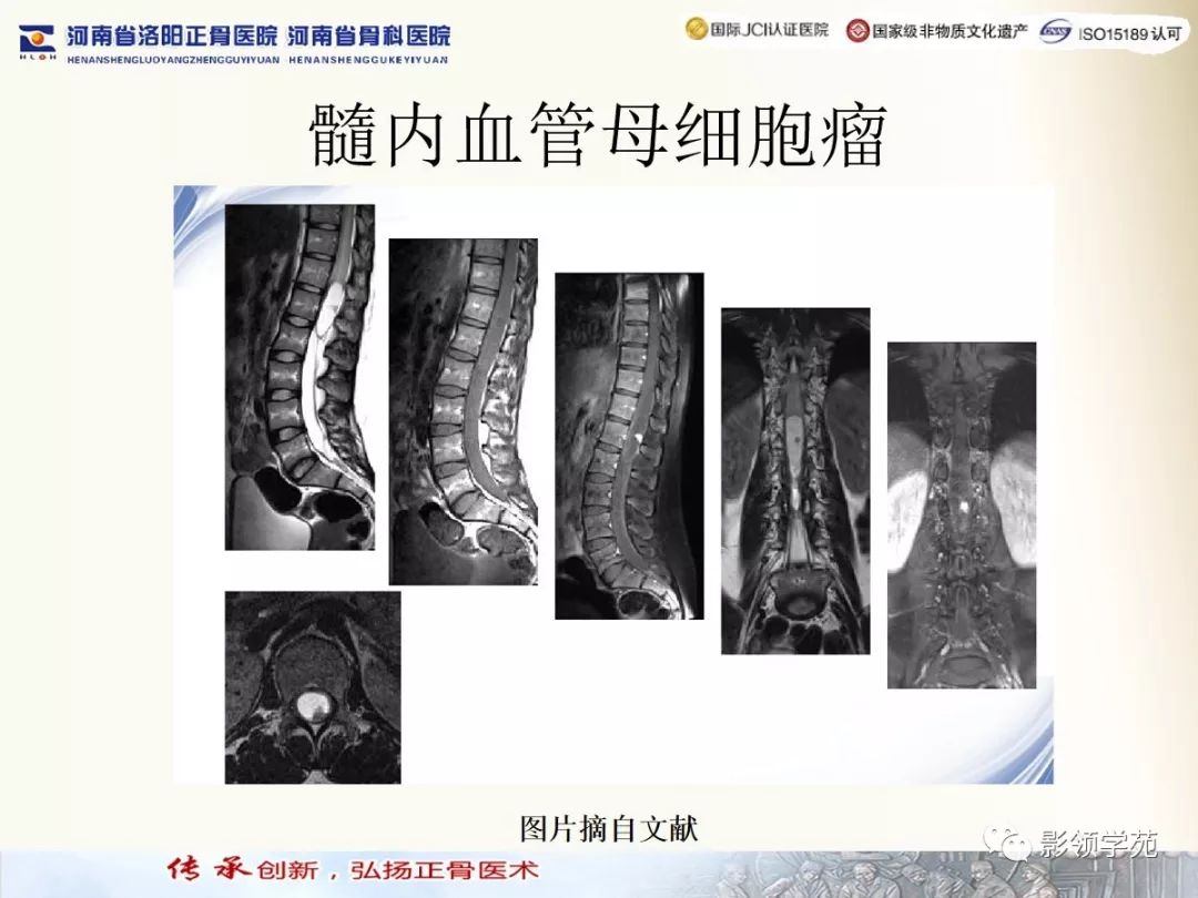 影像PPT - 【PPT】椎管内常见肿瘤MR诊断-13 影像PPT - 【PPT】椎管内常见肿瘤MR诊断-13